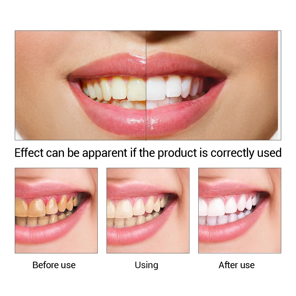 FTEENPLY Zahnaufhellung Essenz – Teeth Whitening Session Bewertung und Preis