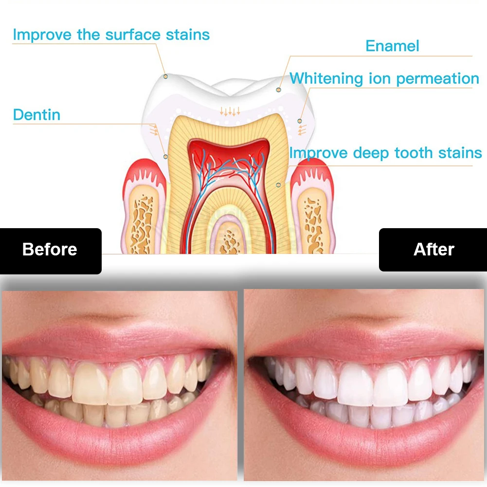 Dental Zahnaufhellung Kit Mini – Teeth Whitening Laser Bewertung und Preis